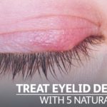 eyelid eczema treatment