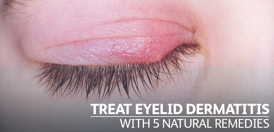 eyelid eczema treatment