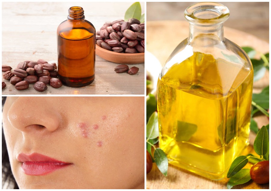 jojoba oil acne