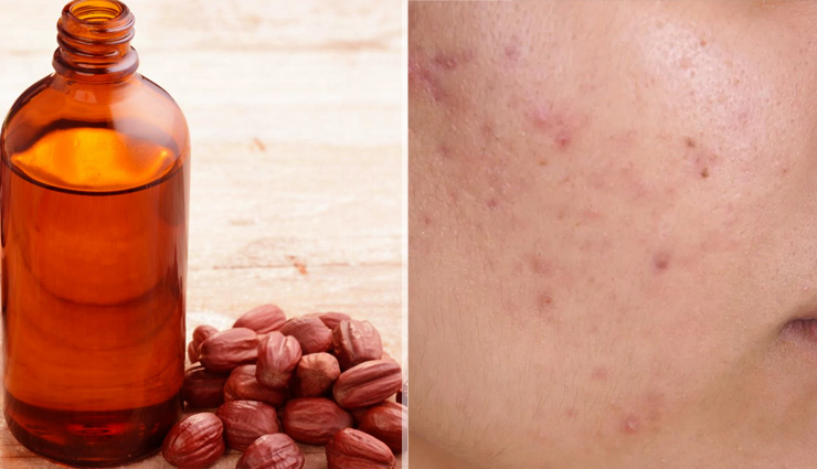 jojoba oil acne