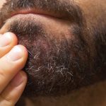 Dry Skin under Beard