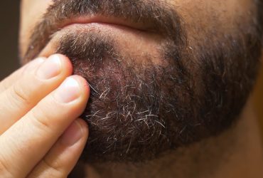 Dry Skin under Beard
