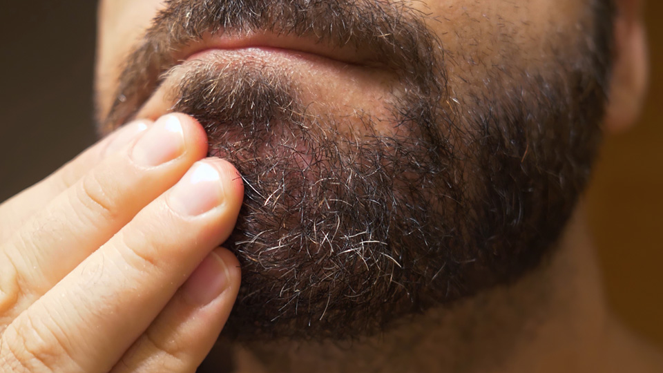 Dry Skin under Beard