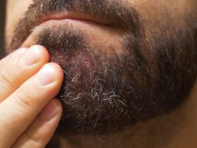 Dry Skin under Beard