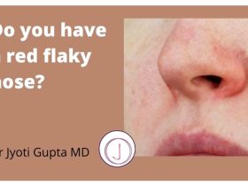 How to Treat Dry Skin around Nose