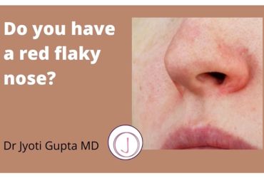 How to Treat Dry Skin around Nose