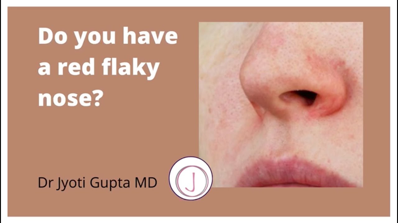 How to Treat Dry Skin around Nose