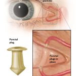 Severe Dry Eyes Images