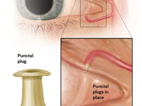 Severe Dry Eyes Images