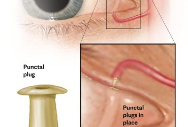Severe Dry Eyes Images