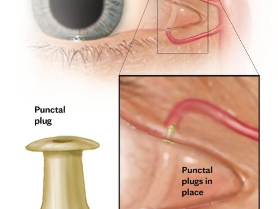 Severe Dry Eyes Images