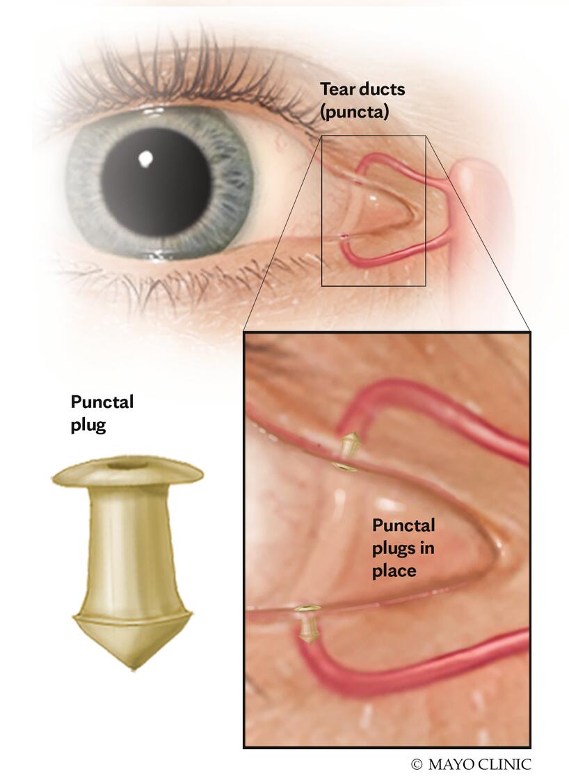 Severe Dry Eyes Images