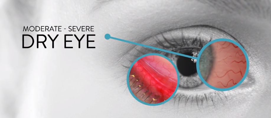 symptoms for dry eyes