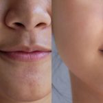 skin whitening treatment near me