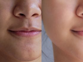 skin whitening treatment near me