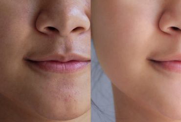 skin whitening treatment near me