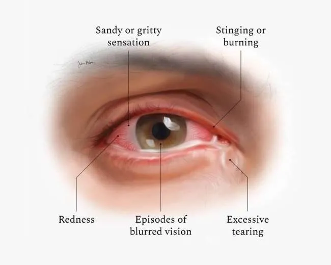 dry eyes symptoms