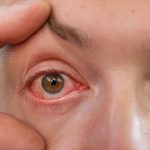 dry eyes and contacts