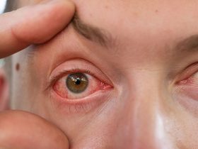 dry eyes and contacts