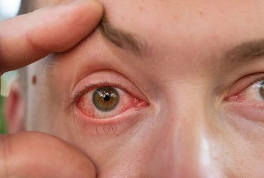 dry eyes and contacts