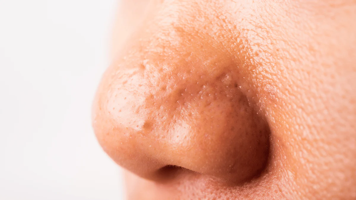 Dry Skin Around The Nose