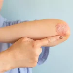 stds that cause dry skin