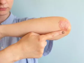 stds that cause dry skin