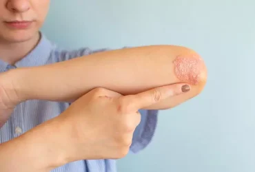 stds that cause dry skin
