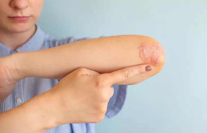 stds that cause dry skin