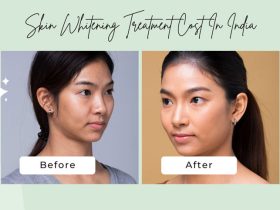 Skin Whitening Laser Treatment