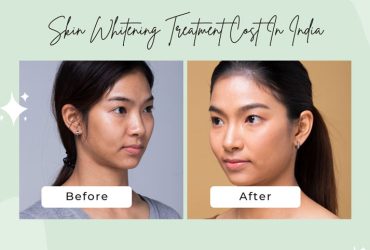 Skin Whitening Laser Treatment