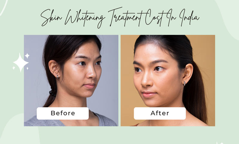 Skin Whitening Laser Treatment