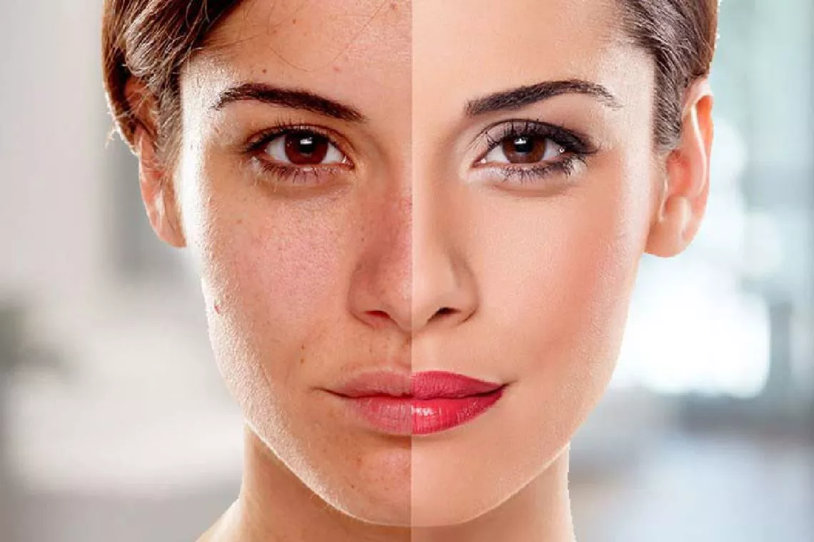 skin whitening laser treatment cost