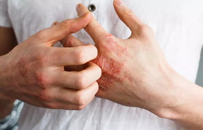 stds that cause dry skin Symptoms