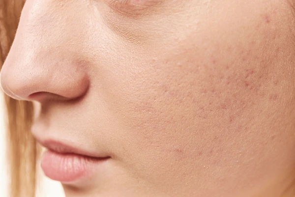 why do i have dry skin on my penis