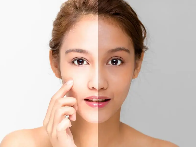 skin whitening laser treatment 