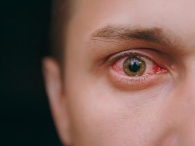 eye wipes for dry eyes