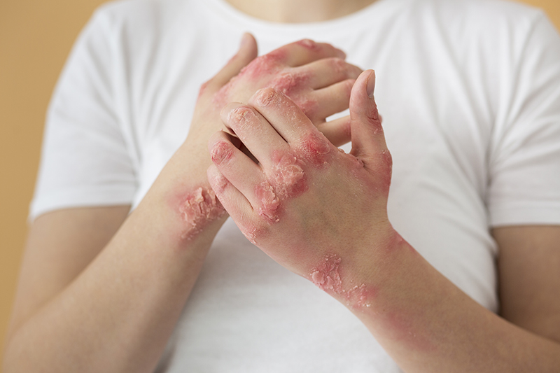 dry skin icd 10