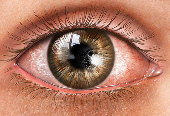 Diagnosing Dry Eyes