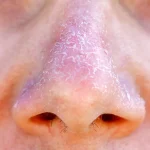 dry skin around nose