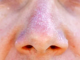 dry skin around nose