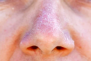 dry skin around nose