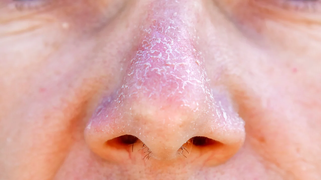 dry skin around nose