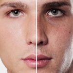 Skin Whitening Treatment