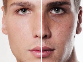 Skin Whitening Treatment