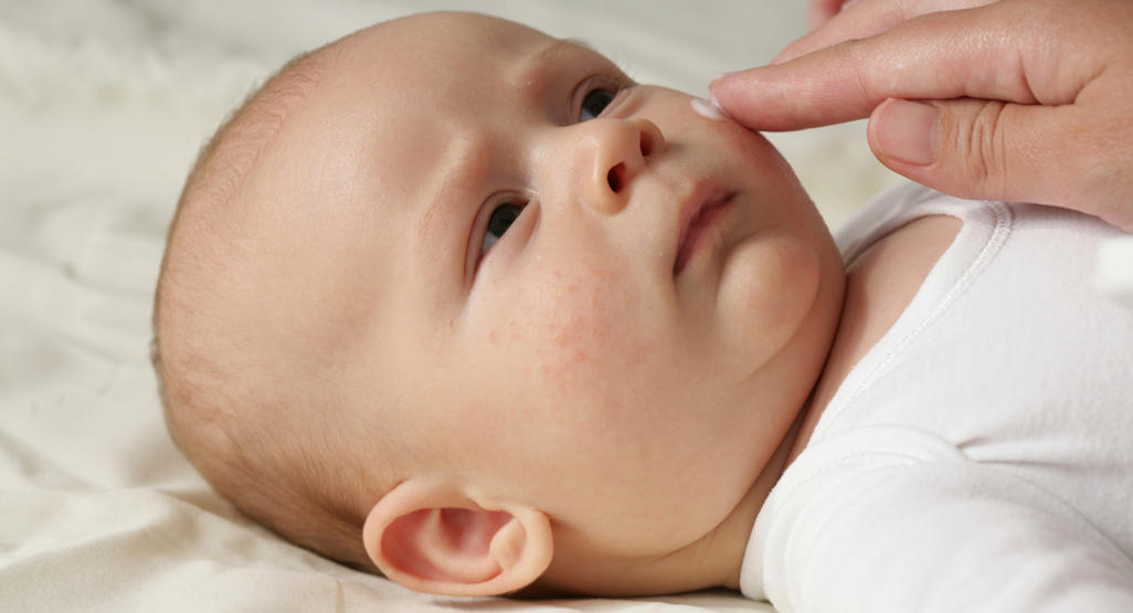 Causes of Newborn Dry Skin