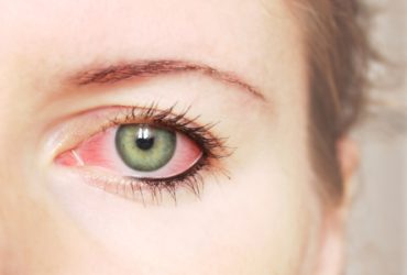 dry eyes and contacts