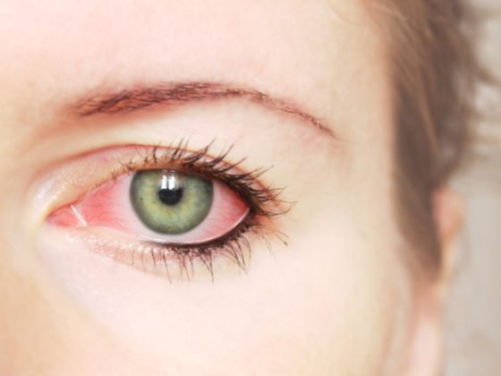 dry eyes and contacts