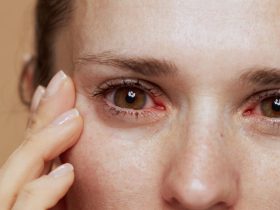 accutane dry eyes