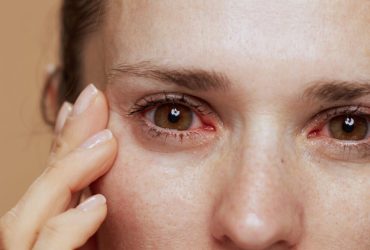 accutane dry eyes